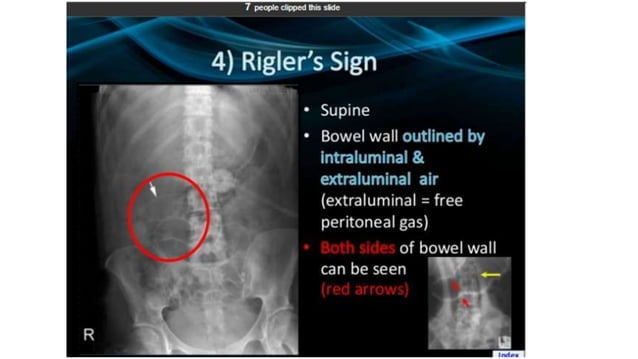 RADIOGRAFI_ABDOMEN_radiologi_abdomen_.pptx