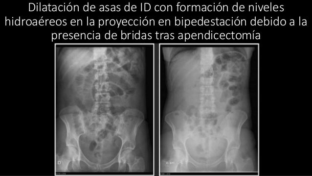 Radiografia De Abdomen Patologia radiografia-de-abdomen-patologia