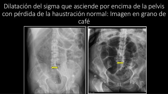 Radiografia de abdomen patologia