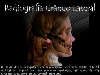 Alinear Lineainfraorbito-meatal (LIOM, línea roja en la imagen) perpendicular a la superficie