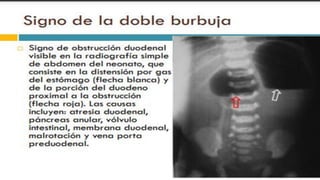 RADIOGRAFIA DEL INTESTINO DELGADO.pdf