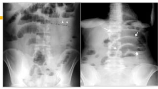 RADIOGRAFIA DEL INTESTINO DELGADO.pdf