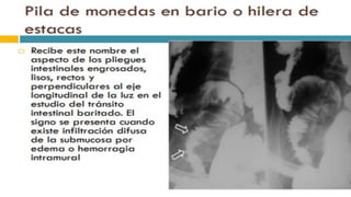 RADIOGRAFIA DEL INTESTINO DELGADO.pdf