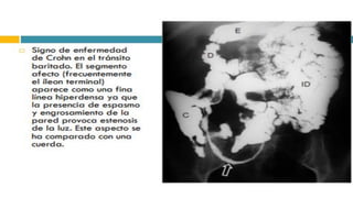 RADIOGRAFIA DEL INTESTINO DELGADO.pdf