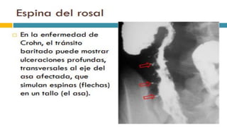 RADIOGRAFIA DEL INTESTINO DELGADO.pdf