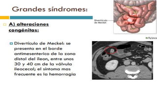 RADIOGRAFIA DEL INTESTINO DELGADO.pdf
