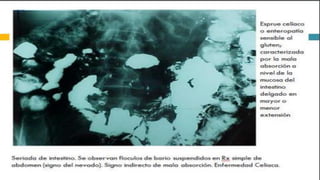 RADIOGRAFIA DEL INTESTINO DELGADO.pdf