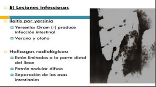 RADIOGRAFIA DEL INTESTINO DELGADO.pdf