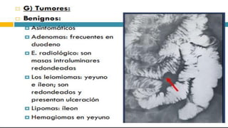 RADIOGRAFIA DEL INTESTINO DELGADO.pdf