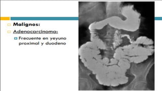 RADIOGRAFIA DEL INTESTINO DELGADO.pdf