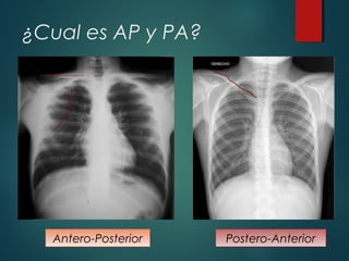 ¿Cual es AP y PA?
Antero-Posterior Postero-Anterior
 