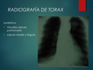 RADIOGRAFÍA DE TORAX
Lordótica:
• Visualiza ápices
pulmonares
• Lóbulo medio y língula
 
