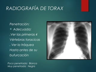 RADIOGRAFÍA DE TORAX
Penetración:
 Adecuada:
.Ver las primeras 4
Vértebras toracicas
. Ver la tráquea
Hasta antes de su
bufurcación
Poco penetrada: Blanca
Muy penetrada: Negra
 