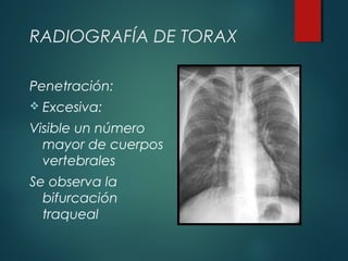 RADIOGRAFÍA DE TORAX
Penetración:
 Excesiva:
Visible un número
mayor de cuerpos
vertebrales
Se observa la
bifurcación
traqueal
 