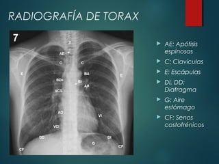  AE: Apófisis
espinosas
 C: Clavículas
 E: Escápulas
 DI, DD:
Diafragma
 G: Aire
estómago
 CF: Senos
costofrénicos
RADIOGRAFÍA DE TORAX
 