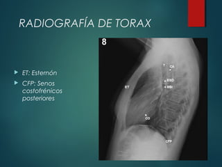  ET: Esternón
 CFP: Senos
costofrénicos
posteriores
RADIOGRAFÍA DE TORAX
 