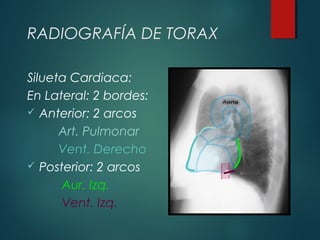 RADIOGRAFÍA DE TORAX
Silueta Cardiaca:
En Lateral: 2 bordes:
 Anterior: 2 arcos
Art. Pulmonar
Vent. Derecho
 Posterior: 2 arcos
Aur. Izq.
Vent. Izq.
 