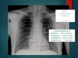 AA
BB
CC
ICT =
3cm+4.5cm
14.8 cm
= 0.5
CARDIOMEGALIA
GRADO I 0.51 A 0.55
GRADO II 0.56 A 0.60
GRADO III 0.61 A 0.65
GRAGO IV > DE 0.65
 