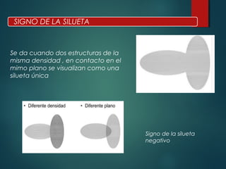 SIGNO DE LA SILUETA
Se da cuando dos estructuras de la
misma densidad , en contacto en el
mimo plano se visualizan como una
silueta única
Signo de la silueta
negativo
 