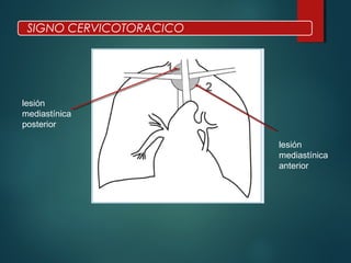 lesión
mediastínica
posterior
lesión
mediastínica
anterior
SIGNO CERVICOTORACICO
 