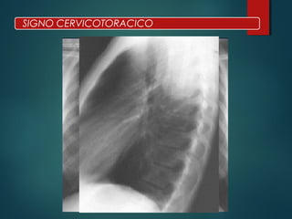 SIGNO CERVICOTORACICO
 