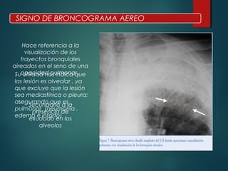 SIGNO DE BRONCOGRAMA AEREO
Hace referencia a la
visualización de los
trayectos bronquiales
aireados en el seno de una
opacidad pulmonar.
Secundario a la
presencia de
exudado en los
alveolos
Su utilidad nos indica que
las lesión es alveolar , ya
que excluye que la lesión
sea mediastínica o pleura;
asegurando que es
pulmonar (neumonía ,
edema e infarto)
 