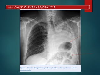 ELEVACION DIAFRAGMATICA
 
