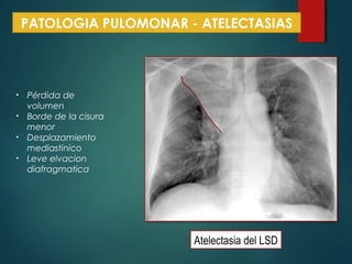 PATOLOGIA PULOMONAR - ATELECTASIAS
• Pérdida de
volumen
• Borde de la cisura
menor
• Desplazamiento
mediastinico
• Leve elvacion
diafragmatica
Atelectasia del LSD
 