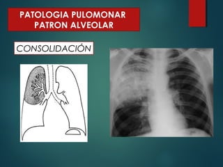 CONSOLIDACIÓN
PATOLOGIA PULOMONAR
PATRON ALVEOLAR
 