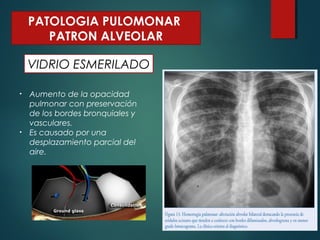 VIDRIO ESMERILADO
PATOLOGIA PULOMONAR
PATRON ALVEOLAR
• Aumento de la opacidad
pulmonar con preservación
de los bordes bronquiales y
vasculares.
• Es causado por una
desplazamiento parcial del
aire.
 