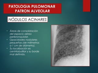 NÓDULOS ACINARES
PATOLOGIA PULOMONAR
PATRON ALVEOLAR
• Áreas de consolidación
del espacio aéreo
peribronquiolar.
• Opacidades nodulares
pequeñas (de milímetros
a 1 cm de diámetro).
• Su localización es
centrilobulillar y su borde
mal definido.
 