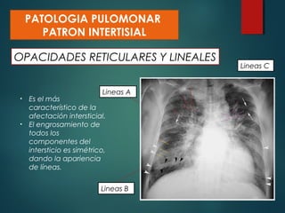 OPACIDADES RETICULARES Y LINEALES
PATOLOGIA PULOMONAR
PATRON INTERTISIAL
• Es el más
característico de la
afectación intersticial.
• El engrosamiento de
todos los
componentes del
intersticio es simétrico,
dando la apariencia
de líneas.
Lineas A
Lineas B
Lineas C
 