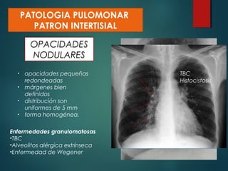 OPACIDADES
NODULARES
PATOLOGIA PULOMONAR
PATRON INTERTISIAL
• opacidades pequeñas
redondeadas
• márgenes bien
definidos
• distribución son
uniformes de 5 mm
• forma homogénea.
Enfermedades granulomatosas
•TBC
•Alveolitos alérgica extrínseca
•Enfermedad de Wegener
TBC
Histocistosis
 