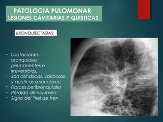 • Dilataciones
bronquiales
permanentes e
irreversibles.
• Son cilíndricas, varicosas
y quísticas o saculares.
• Fibrosis peribronquiales
• Pérdida de volumen.
• Signo del “riel de tren
PATOLOGIA PULOMONAR
LESIONES CAVITARIAS Y QUISTICAS
BRONQUIECTASIAS:
 