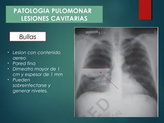 Bullas
PATOLOGIA PULOMONAR
LESIONES CAVITARIAS
• Lesion con contenido
aereo
• Pared fina
• Dimeatro mayor de 1
cm y espesor de 1 mm
• Pueden
sobreinfectarse y
generar niveles.
 