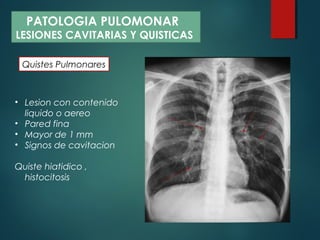 Quistes Pulmonares
PATOLOGIA PULOMONAR
LESIONES CAVITARIAS Y QUISTICAS
• Lesion con contenido
liquido o aereo
• Pared fina
• Mayor de 1 mm
• Signos de cavitacion
Quiste hiatidico ,
histocitosis
 