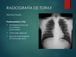 RADIOGRAFÍA DE TORAX
Posteroanterior ( PA):
 Omóplatos fuera de
los campos
pulmonares
 Clavículas oblicuas
 Espacio intervertebral
en forma de romo
PROYECCIONES:
 