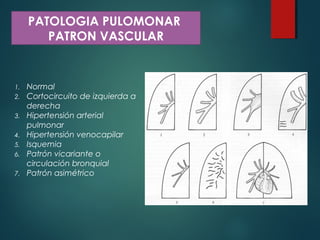 PATOLOGIA PULOMONAR
PATRON VASCULAR
1. Normal
2. Cortocircuito de izquierda a
derecha
3. Hipertensión arterial
pulmonar
4. Hipertensión venocapilar
5. Isquemia
6. Patrón vicariante o
circulación bronquial
7. Patrón asimétrico
 