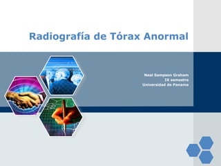 LOGO
Radiografía de Tórax Anormal
Neal Sampson Graham
IX semestre
Universidad de Panama
 