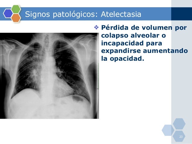 Radiografia de torax anormal pdf