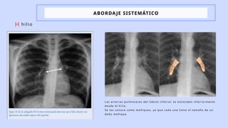 Focomelia Rx RADIOGRAFIA DE TORAX_ELVIRAROBLES PPTX 2 | PPTX