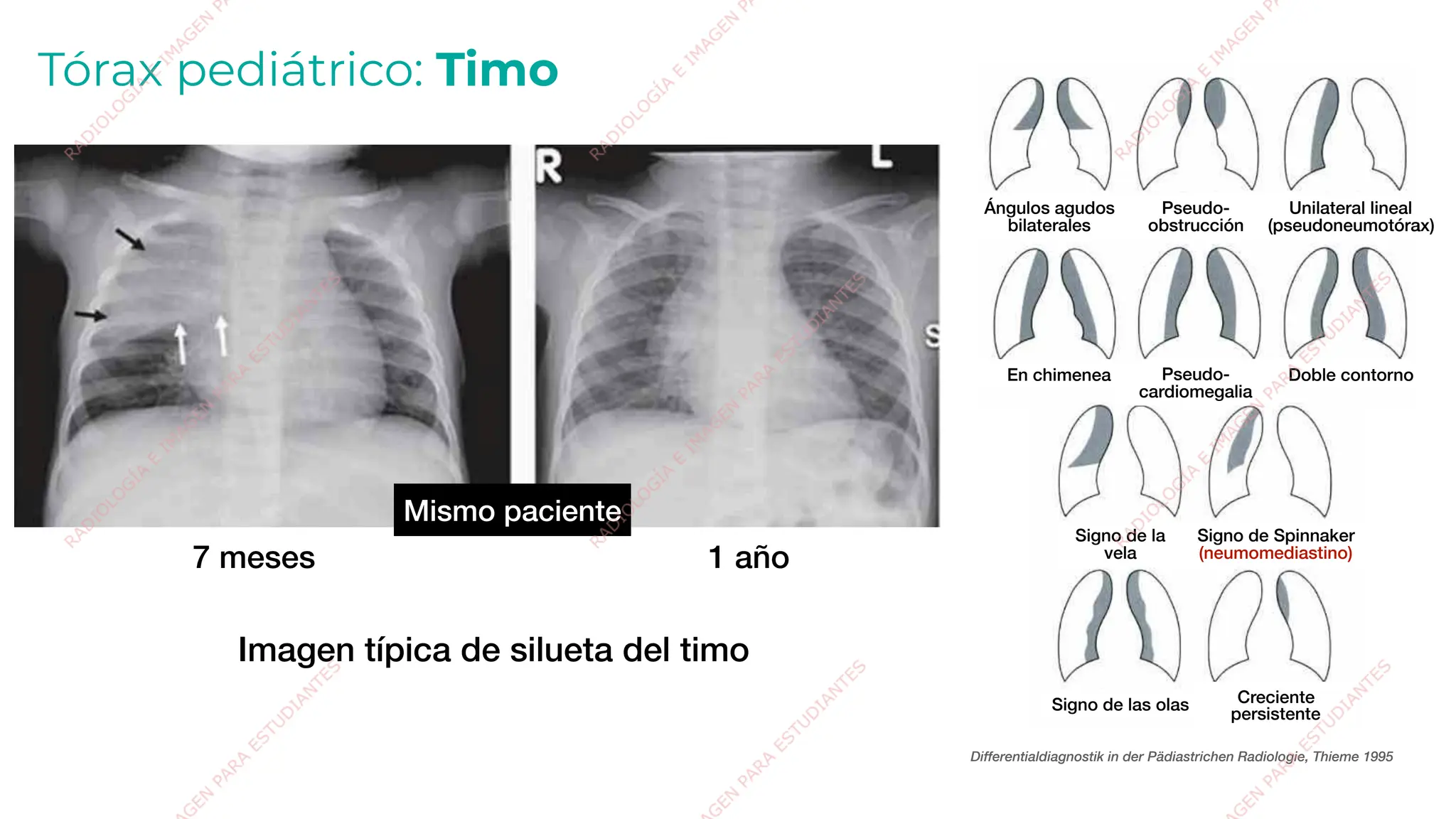 Torax Inestable Rx Radiografía de tórax pediátrico internado médico | PDF