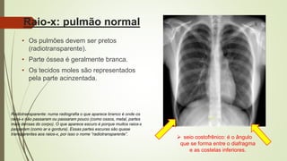 Raio-x: pulmão normal
• Os pulmões devem ser pretos
(radiotransparente).
• Parte óssea é geralmente branca.
• Os tecidos moles são representados
pela parte acinzentada.
 seio costofrênico: é o ângulo
que se forma entre o diafragma
e as costelas inferiores.
Radiotransparente: numa radiografia o que aparece branco é onde os
raios-x não passaram ou passaram pouco (como ossos, metal, partes
mais densas do corpo). O que aparece escuro é porque muitos raios-x
passaram (como ar e gordura). Essas partes escuras são quase
transparentes aos raios-x, por isso o nome “radiotransparente”.
 
