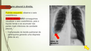 Derrame pleural à direita.
Pulmão esquerdo: observe o seio
costofrênico.
Pulmão direito: NÃO conseguimos
visualizar o seio costofrênico, pois o
líquido tende a se acumular nas
partes mais inferiores da cavidade
pleural.
• Compressão do tecido pulmonar do
parênquima gerando uma dispneia
(falta de ar).
SINAL DE
MENISCO
 