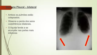 Derrame Pleural – bilateral
• Ambos os pulmões estão
colapsados.
• Observe a perda dos seios
costofrênicos bilaterais.
• O líquido tende a se
acumular nas partes mais
inferiores
 
