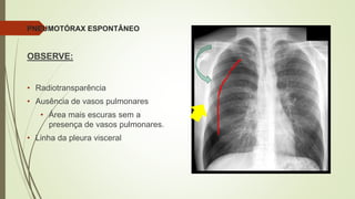 PNEUMOTÓRAX ESPONTÂNEO
OBSERVE:
• Radiotransparência
• Ausência de vasos pulmonares
• Área mais escuras sem a
presença de vasos pulmonares.
• Linha da pleura visceral
 