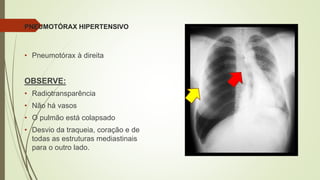 PNEUMOTÓRAX HIPERTENSIVO
• Pneumotórax à direita
OBSERVE:
• Radiotransparência
• Não há vasos
• O pulmão está colapsado
• Desvio da traqueia, coração e de
todas as estruturas mediastinais
para o outro lado.
 