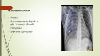 HEMOPNEUMOTÓRAX
• Projétil
• Borda do pulmão (líquido e
gás no espaço pleural)
• Hemotórax
• Enfisema subcutâneo
 