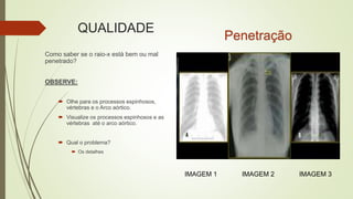 QUALIDADE
Como saber se o raio-x está bem ou mal
penetrado?
OBSERVE:
 Olhe para os processos espinhosos,
vértebras e o Arco aórtico.
 Visualize os processos espinhosos e as
vértebras até o arco aórtico.
 Qual o problema?
 Os detalhes
Penetração
IMAGEM 1 IMAGEM 2 IMAGEM 3
 