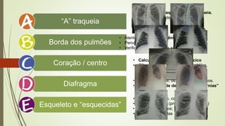 “A” traqueia
Borda dos pulmões
Coração / centro
Diafragma
Esqueleto e “esquecidas”
• Olhe para a traqueia, siga a traqueia.
• Está centralizada ou com desvio
traqueal?
• Atente para a transparência pulmonar;
• Percorra as margens;
• Verifique se os pulmões são simétricos.
• Calcule o Índice Cardiotorácico
• Olhe o centro- vasos da base, Hilos,
mediastino, cavidades
• Olhe as cúpulas, os seios costofrênicos.
• Vá em busca de derrames e “d’Hérnias”
• Procure fraturas, calos ósseos
• Ar fora do lugar (pneumo’s, enfisema)
• Corpos estranhos;
• Zonas esquecidas
 